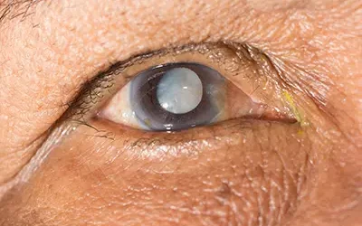 Cataract Surgery Re-Visited